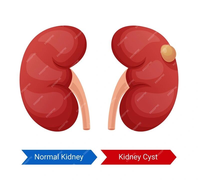 Understanding Kidney Cysts Causes, Symptoms, and Treatment